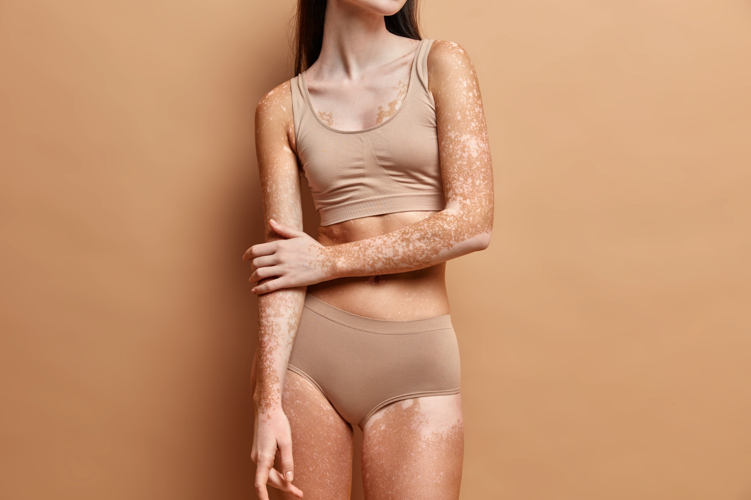 vitiligo