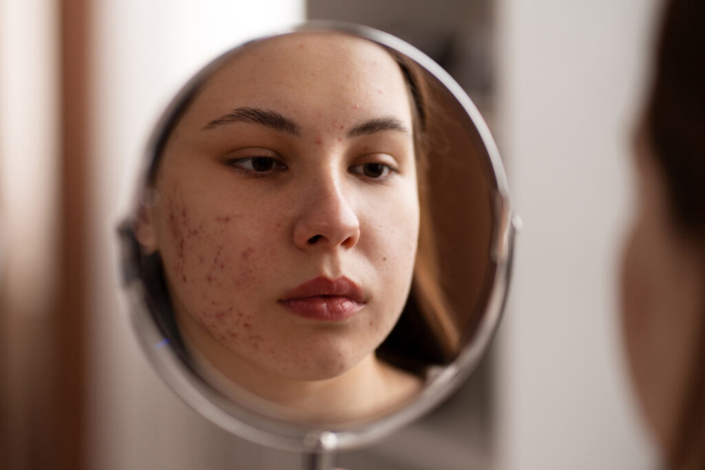 Mulher com acne